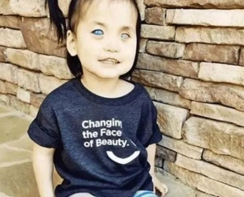 蓝色瞳孔奇缘：基因突变下的瓦登伯格综合征女孩