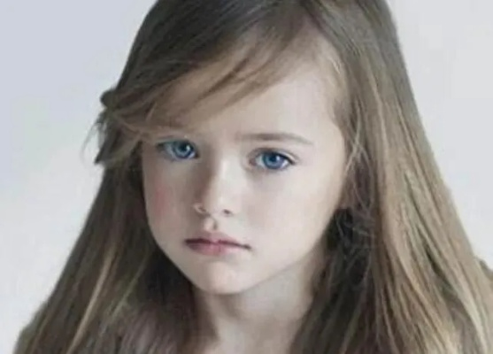 蓝色瞳孔奇缘：基因突变下的瓦登伯格综合征女孩