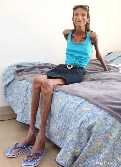 土耳其网红挑战极限，厌食症悲剧离世：体重仅剩23公斤