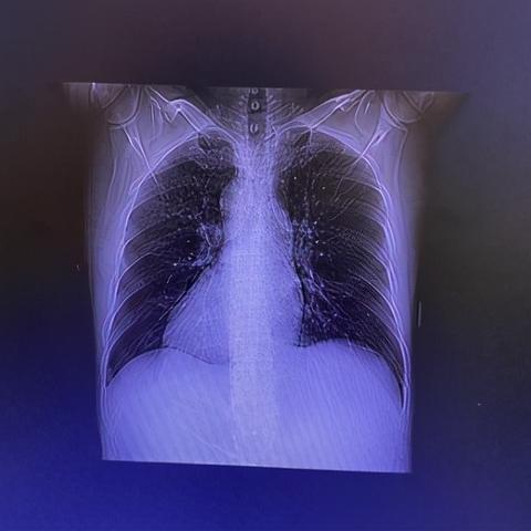 高压线钓鱼悲剧！男子全身80%烧伤，4000斤鱼电死！