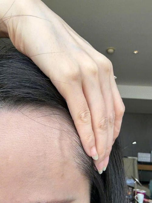 张靓颖体检惊曝营养不良：伸懒腰手掌出血惊魂！