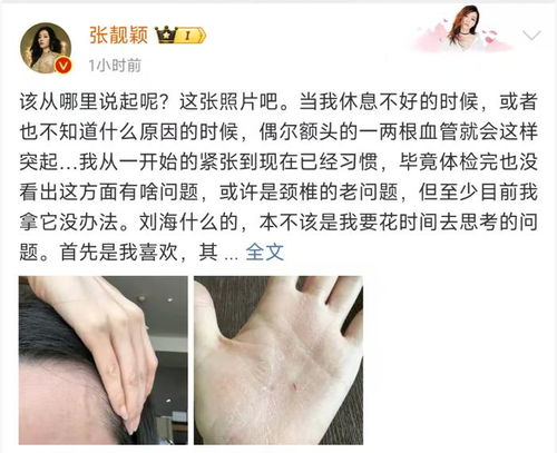 张靓颖体检惊曝营养不良：伸懒腰手掌出血惊魂！