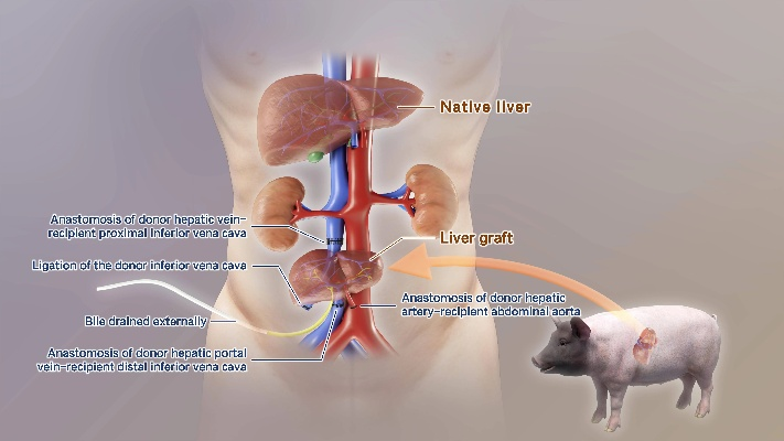 基因编辑猪肺移植突破！中国团队再创医学奇迹