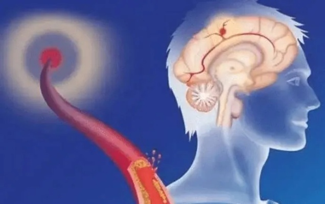 三甲脑梗专家过劳中招，揭秘治疗脑梗背后的真相