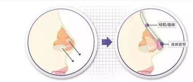 男子鼻痛18年终解谜：神秘骨瘤内藏树枝，开刀取出3cm奇迹！