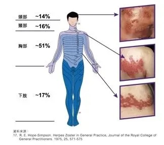 蔡依林患蛇缠腰，揭秘睡眠在人生中的关键作用！