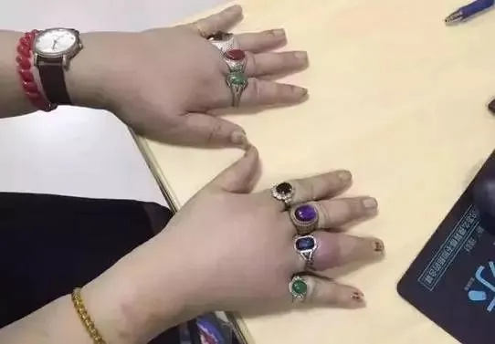 十年戴镯致肉嵌感染，揭秘女性健康警示新案例