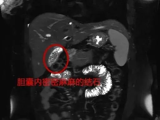 女子体内取出几百颗结石？游戏玩家更该懂的「身体副本隐藏BOSS」