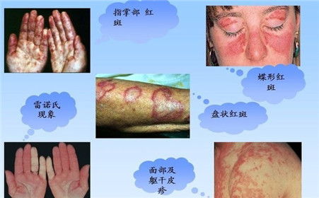 周海媚病逝背后，系统性红斑狼疮2025最新诊疗指南与生存法则全解析