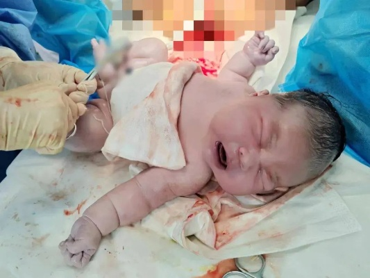 12.9斤巨婴分娩实战全解析，产科专家揭秘罕见巨大儿成因、风险与新生儿急救方案