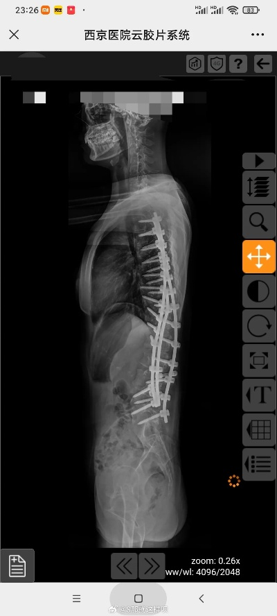 脊柱侧弯术后暴增21厘米？揭秘重度畸形矫正的身高逆袭医学真相